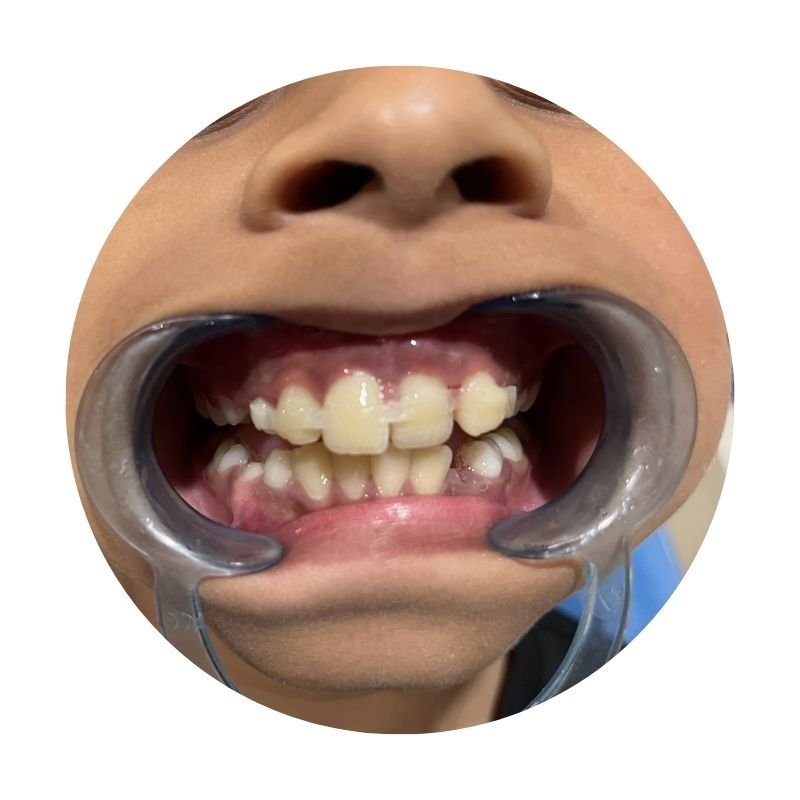 Treatment of Trauma & fall injuries in kids