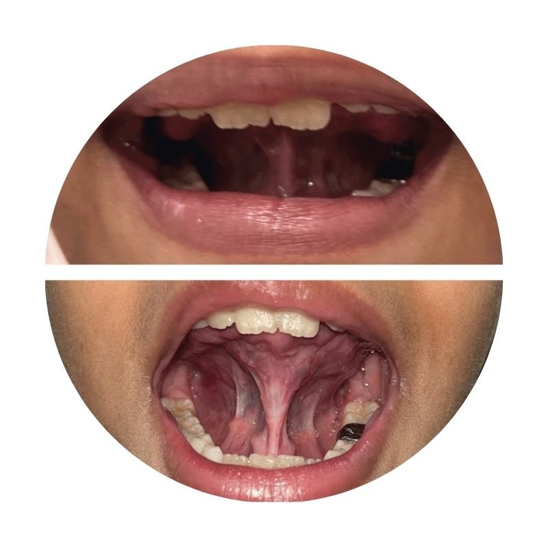 Lasers for tongue tie correction: improves speech, jaw development