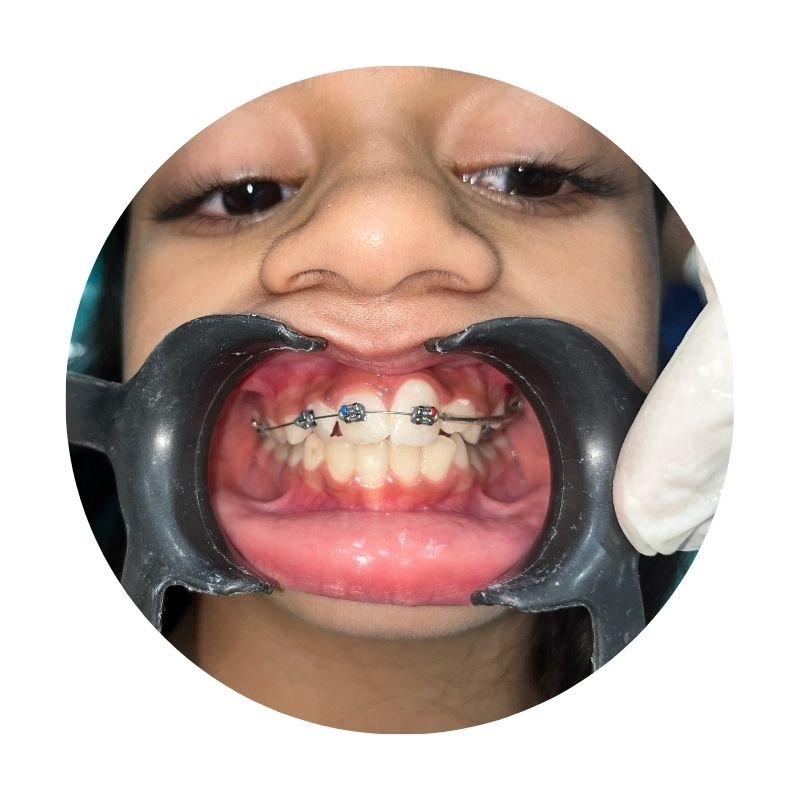 Braces & aligners for overlapping teeth