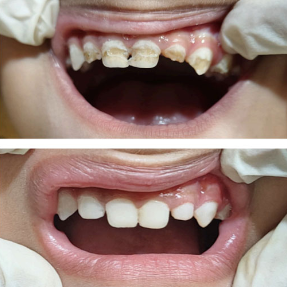 Multiple fillings, RCT & crowns in kids