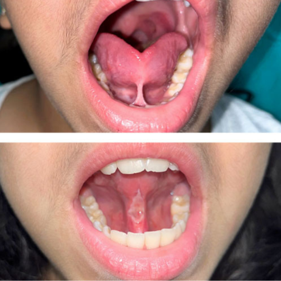 Tongue tie treated using laser in kids to improve speech and jaw development