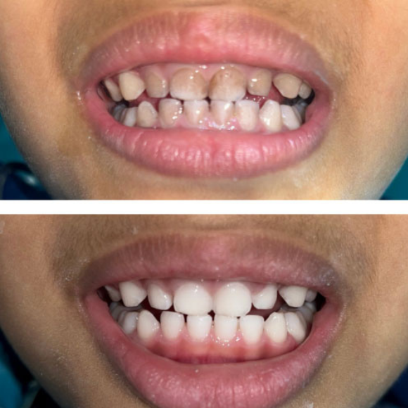 Dental Cleaning & Polishing to remove stains and calculus for children