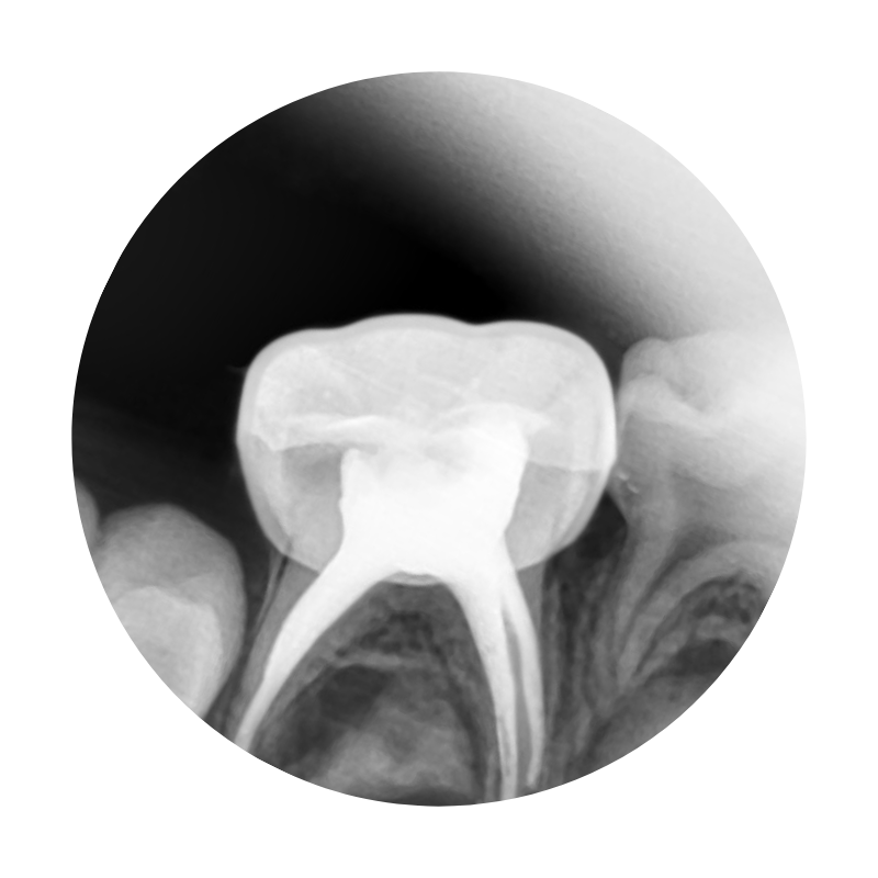 RCT for kids in Nagpur: Painfree and single sitting