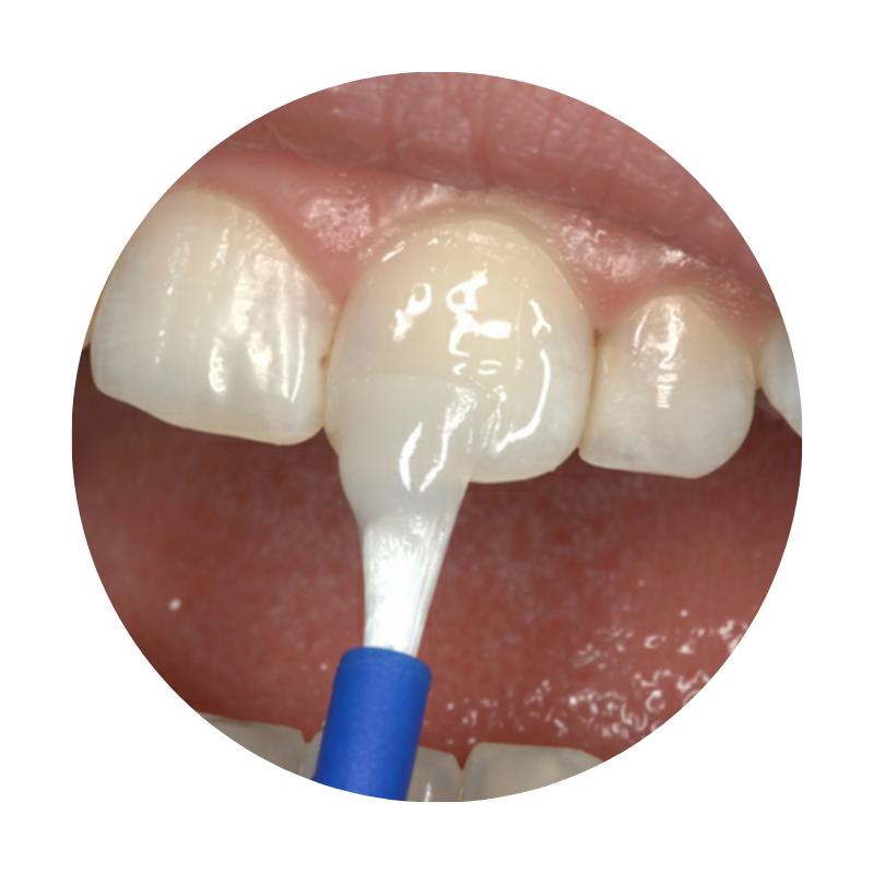 Dental Fluoride in kids for protection against cavities