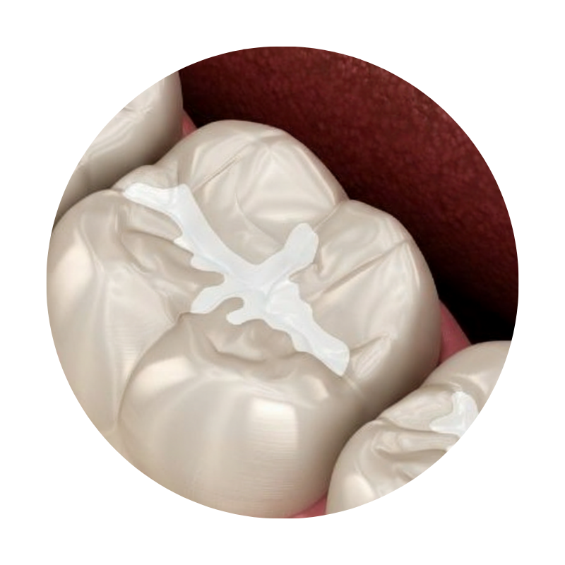 Dental sealants in kids for protection against cavities