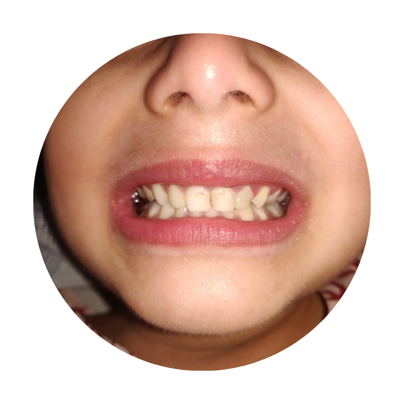 Fillings for kids in Nagpur: aesthetic and painless tooth coloured fillings